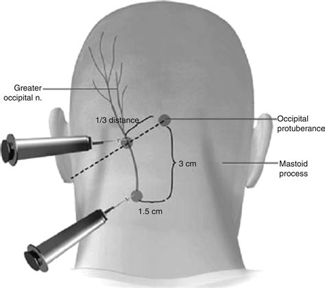 Occipital Neuralgia Anatomy