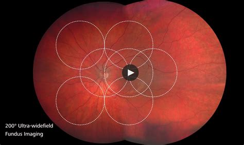 Equipment Debut Ultra Widefield Fundus Imaging Technology Review Of