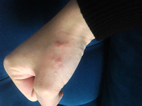 We did not find results for: Komische Punkte auf der Hand? (Ausschlag)