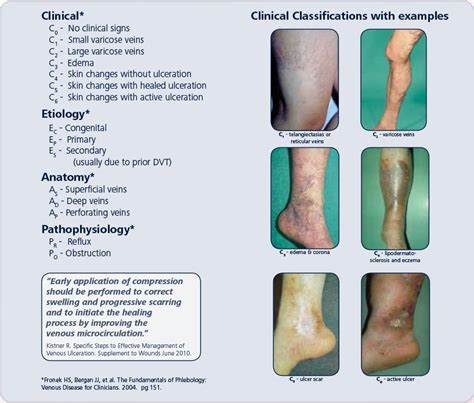 Ceap Classification Of Chronic Venous Disorders Clinical Grepmed