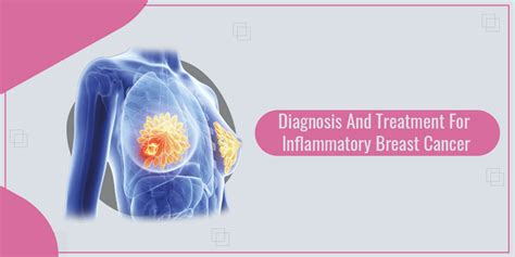 Inflammatory Breast Cancer Survival Rate Archives Universitycancercenters