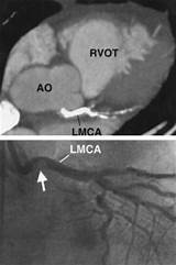 Photos of Coronary Artery Calcification Mayo Clinic