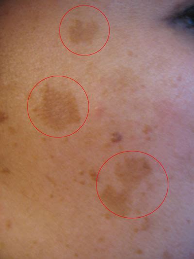 Melasma Chloasma Pictures Dark Skin Pigmentation On Face