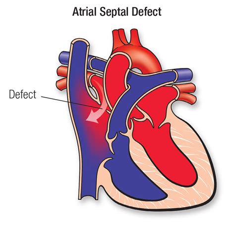 Atrial Septal Defect Asd American Heart Association Cpr And First Aid