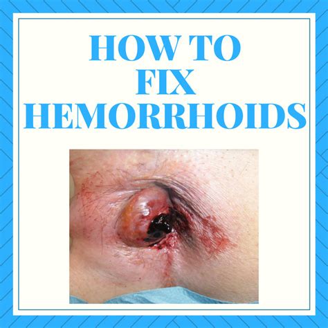 How To Fix Hemorrhoids Fast Naturally And Safely External Internal