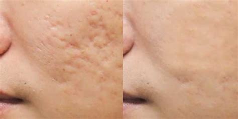Get Rid Of Acne Scars With Radiofrequency Microneedling Amae Med Spa