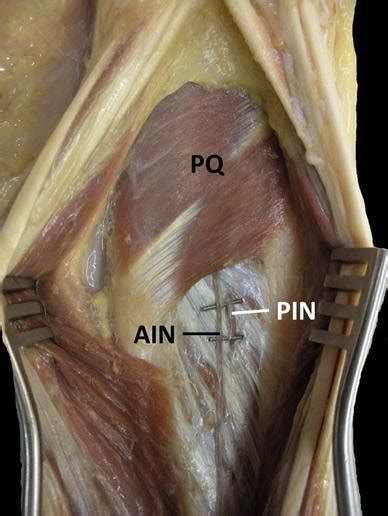 A Right Hand Demonstrates The Volar Approach Identifying The Anterior