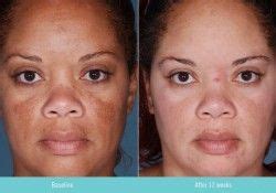 Kombibehandlung für große ziele + intimchirurgie von frauen für frauen schamlippenkorrektur, vaginalverjüngung, bleaching; Pigmentflecken verschwinden, Pigmentflecken Behandlungen ...