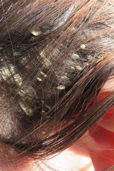 36 Top Photos Baby Dry Scalp Hair Loss Dry Scalp And How It Relates
