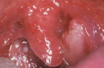 An overall survival rate includes people of all ages and health conditions who have been diagnosed with your cancer, including those diagnosed very early and those. Tonsil Cancer Survival Rate - Cancer News Update