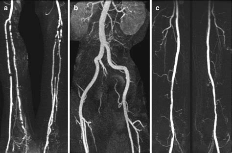 Imaging Approaches And Challenges In The Assessment Of Peripheral