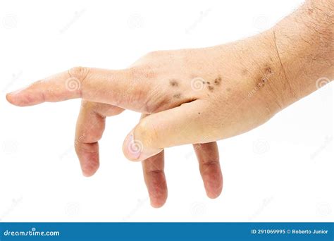 Male Hand Dry And With Skin Spots Dermatological Problem Solar