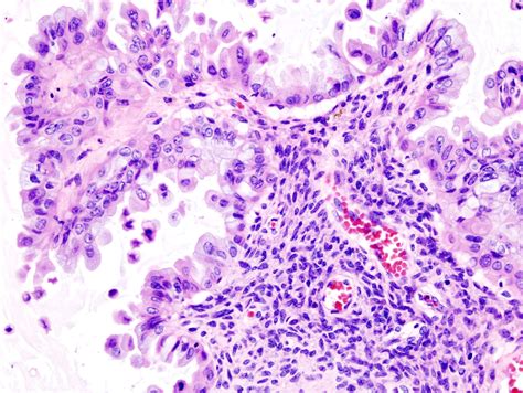 Filemucinous Borderline Tumor Of Ovary 2 Histopatholgy