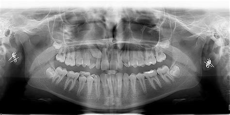 Impacted Tooth Xray Image B Prettyman Orthodontics