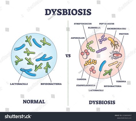 Dysbiosis Versus Normal Gut Tract Microflora Stock Vector Royalty Free