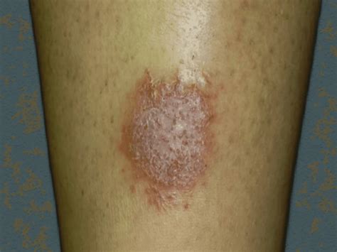 Understanding Discoid Eczema Causes Symptoms And Treatment Ask The