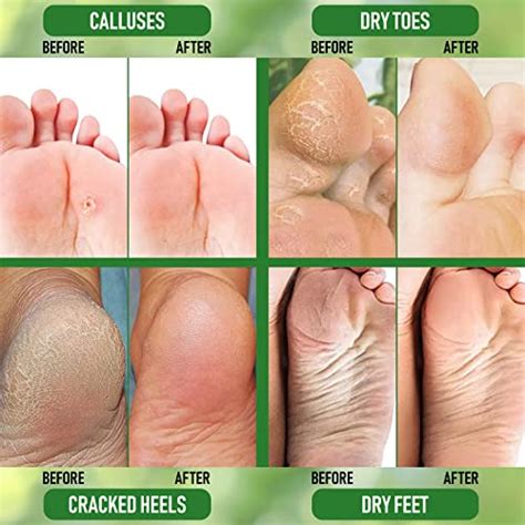 Effective Ways To Remove Thick Calluses From Feet Removemania