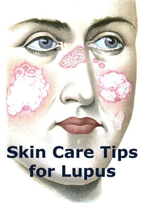 Lupus Skin Care Tips Youmemindbody