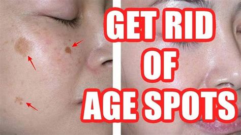 How To Get Rid Of Age Spots On Face Hands Legs Naturally Home Remed Age Spots On Face