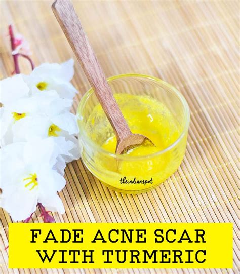 It has anti inflammatory properties. 8 Simple Home Remedies For Scar Removal