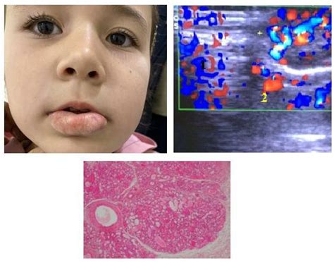 Patient V 1 Year Old Diagnosis Infantile Hemangioma Of The Lower