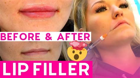 Restylane and juvederm improve fine wrinkles and provide fuller lips and more volume in the face. WOW 💉 Amazing Lip Filler!!! 💉 CANNULA TECHNIQUE ...