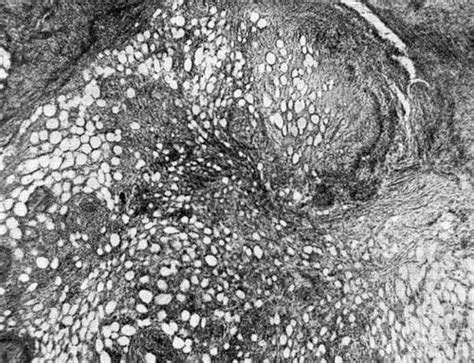 Tb is spread from person to person through the air. Индуративный туберкулез кожи (tuberculosis cutis ...