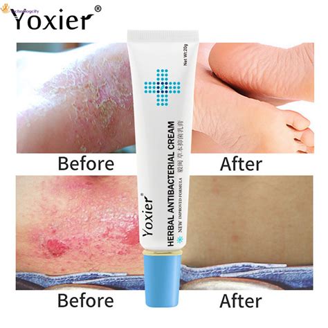 Yoxier Herbal Antibacterial Psoriasis Cream Antipruritic Relief Eczema Rash Skin External