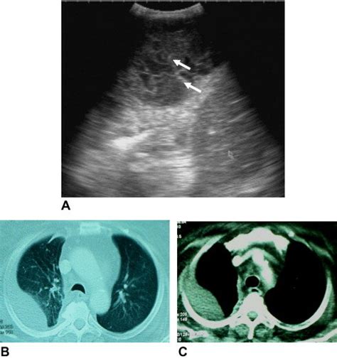 A Chest Us Image In B Mode Shows Moderate Amount Of Highly Echogenic