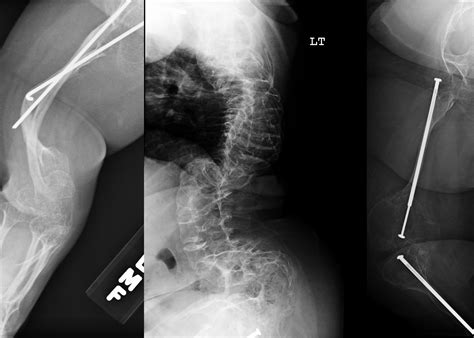 Osteogenesis Imperfecta 101 - Looking Up