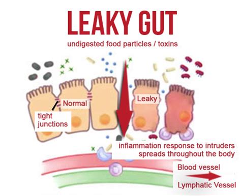 Healing Within With Dr Ezzy Do You Have Leaky Gut Syndrome You May