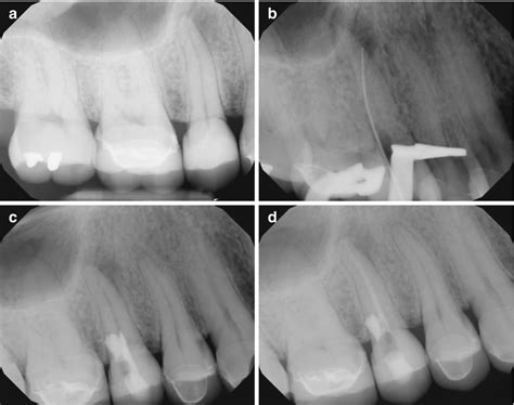 Complications Pocket Dentistry