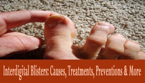 Interdigital Blisters Causes Treatments Preventions And More Blister