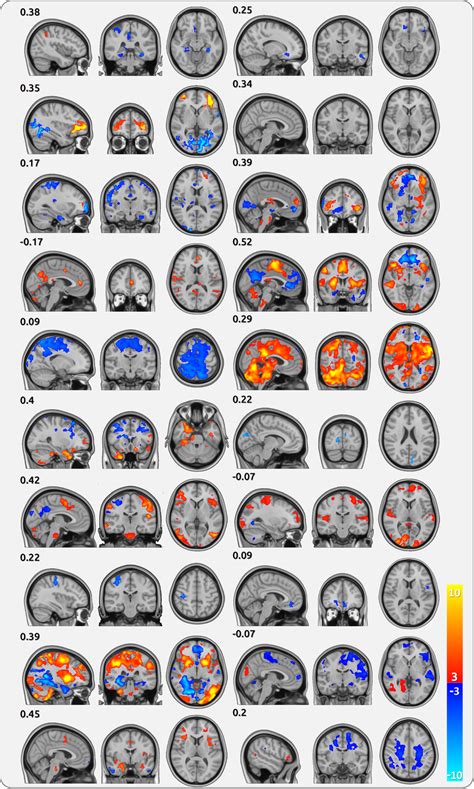 Cortical Processing Of Single Chronic Back Pain Cbp Patients Each