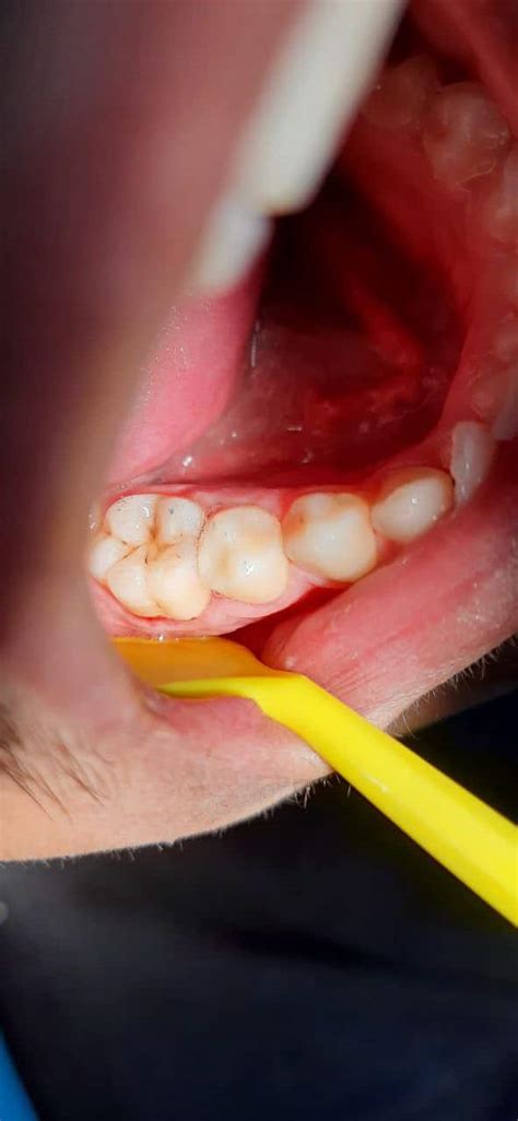 Conservative Restoration For Lower Second Premolar Lower 5 Myzerodonto