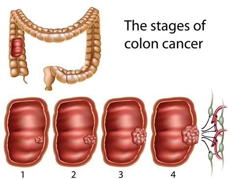 Colon Cancer Treatment Colorectal Cancer Stages And Treatment Options