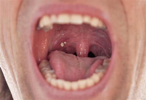 Tonsil Stones And Your Health Pure Holistic Dental