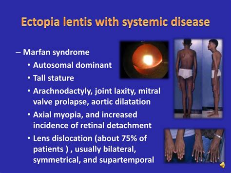 Ppt Ectopia Lentis Powerpoint Presentation Free Download Id4912491