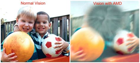 What are the early signs of macular degeneration. Macular Degeneration, What you need to know!
