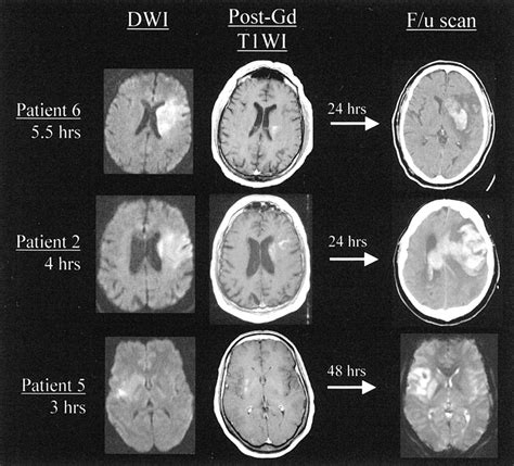 Mr Imaging Enhancement Patterns As Predictors Of Hemorrhagic