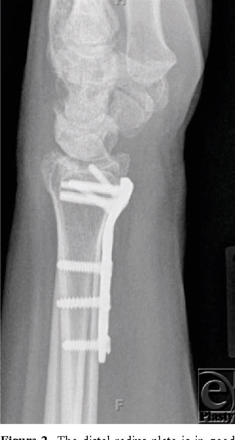 Tendons are strong, dense, uniform connective tissue structures that attach muscles 2. Figure 2 from Flexor Pollicis Longus Tendon Rupture After ...