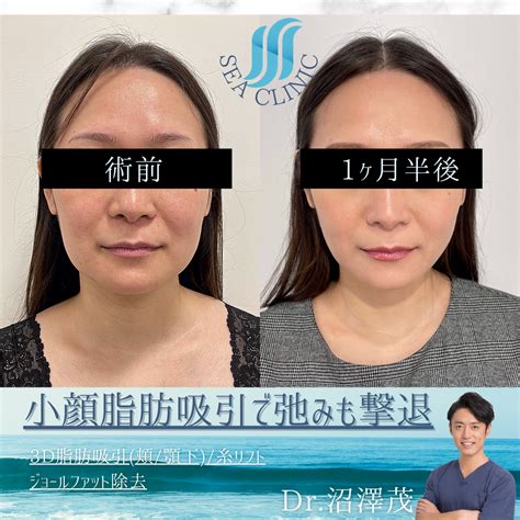 小顔脂肪吸引で弛みも撃退 Sea Clinic −シークリニック 銀座― 理想を叶える小顔治療
