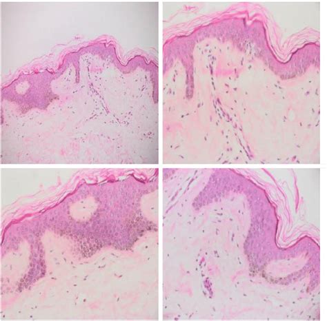 Hematoxylin And Eosin Section Showing Melanin Hyperpigmentation Of