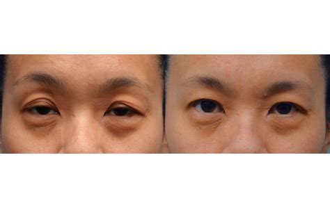Asian Eyelid Surgery Archives Jeffrey M Joseph
