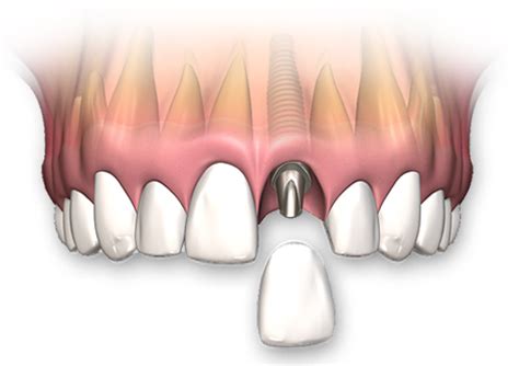 Single Tooth Replacement Implant Dentistry