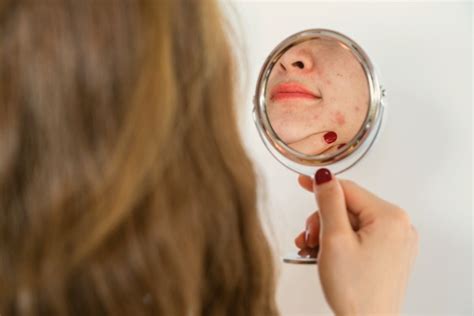 How To Prevent And Treat Acne Breakouts Around Mouth Goodglow