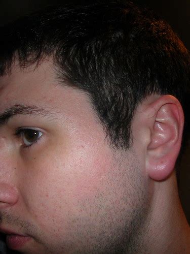Ear Cyst A Sebaceous Cyst In My Ear Its Pretty Much A Clo Flickr