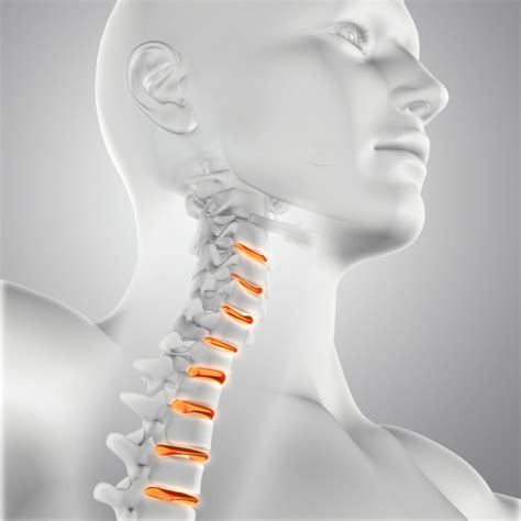 Neck Disc Injury Slipped Neck Disc Slipped The Disc In Your Neck