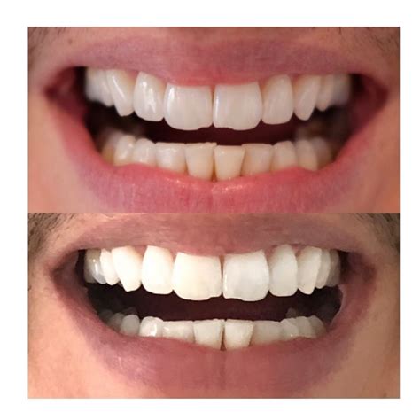 Before And After Invisible Aligners Teeth Straightening Braces