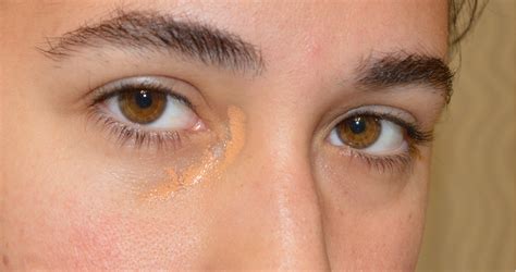 Skin Discoloration Around Eyes